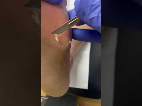 Ultimate Corn & Callus Removal: Watch Podiatrist Transform Your Feet #Podiatry #FootCare