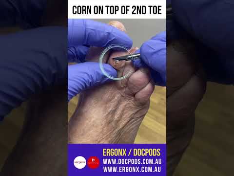 Amazing Corn Removal: Watch a Podiatrist Work Wonders on an Odd Toe #CornRemoval #Podiatry