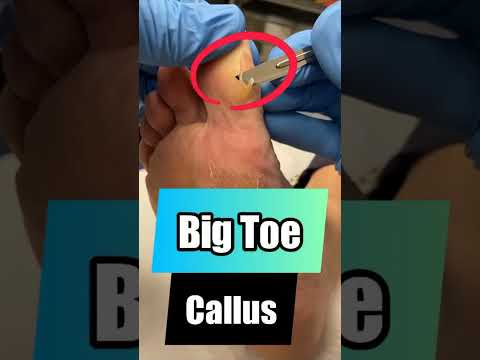Say goodbye to uncomfortable soles! Watch a podiatrist work their magic in a hard skin