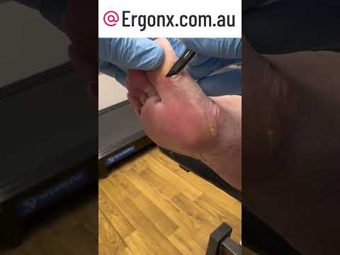 Ultimate Corn & Callus Removal from Big Toe at Podiatry Clinic #FootCare #Podiatry