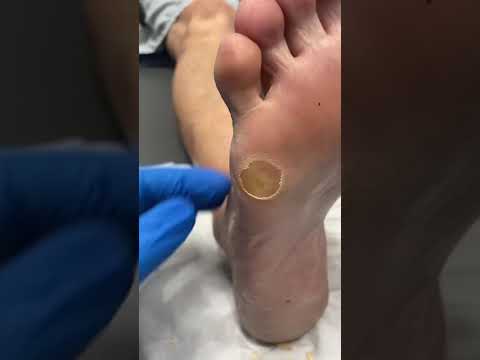Satisfying Corn and Callus Removal by Podiatrist Transformation #FootCare #Podiatry