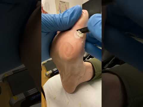 Watch this amazing transformation! 🌟 Wart debriding after salicylic acid treatment by a skilled