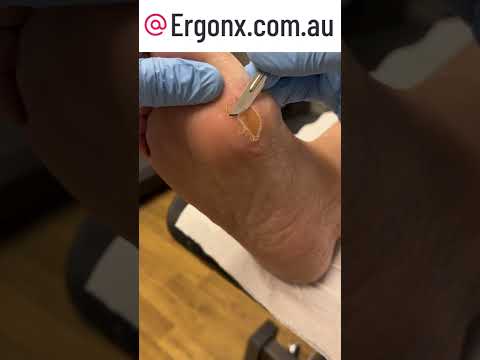Ultimate Thick Callus Removal: Amazingly Satisfying Transformation #Satisfying #CallusRemoval