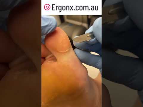 Satisfying Big Toe Callus Removal by Australian Podiatrist ASMR #FootCare #Podiatry
