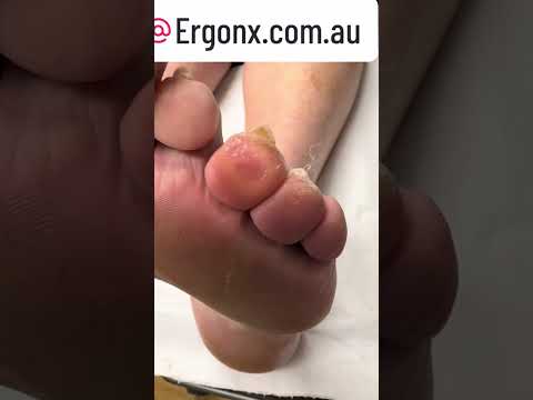 "Ultimate Callus Removal Transformation by Podiatrist #FootCare #Satisfying"