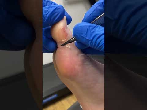 Satisfying Big Toe Callus Removal Unbelievable Transformation #CallusRemoval #FootCare