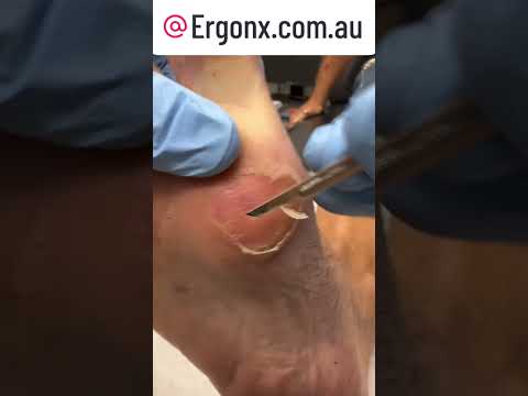 Satisfying Corn & Callus Removal by Podiatrist - Watch the Scalpel Magic! #FootCare #Podiatry