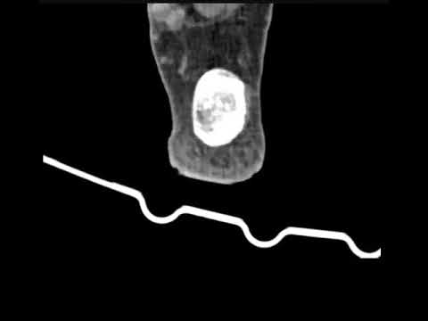 🔍✨ Zoom in on this incredible MRI imaging of a foot A-P! Can you spot the fracture hiding in plain