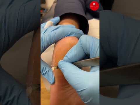 Say goodbye to tough calluses! 🚫👣 Watch me transform my feet with this amazing callus removal