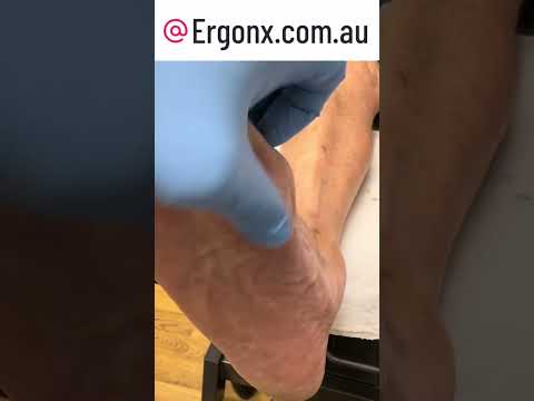 Say Goodbye to Painful Foot Calluses Expert Removal at Podiatry Clinic #FootCare #Podiatry