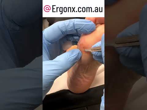 Satisfying Corn & Callus Removal by Expert Podiatrist #FootCare #Podiatry