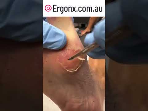Satisfying Corn & Callus Removal by Podiatrist Clinic Transformation #Podiatry #FootCare