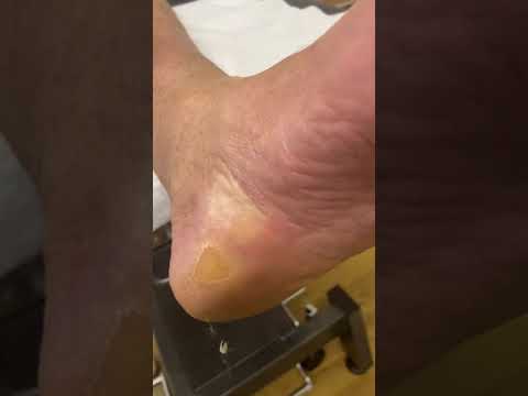 Watch this mesmerizing transformation as a skilled podiatrist works their magic on thick heel