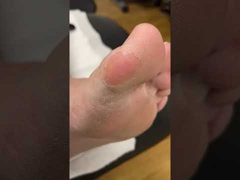 Ultimate Callus Removal Guide: Transform Your Big Toe #FootCare #CallusRemoval