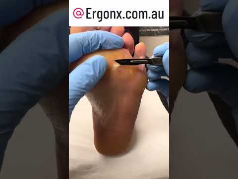 Satisfying Thick Callus Removal Transformation #FootCare #CallusRemoval