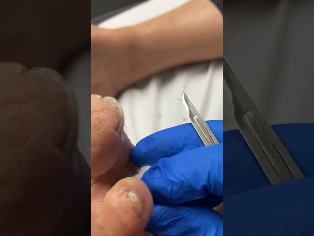 Tip of Toe Callus Removal #corn #callus #docpods #ergonx #toecallus #footcallus #satisfying
