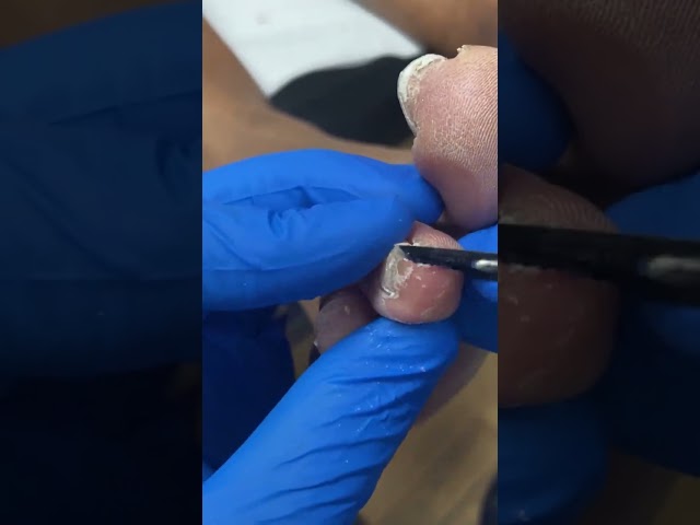 Ultimate Toe Callus Debridement: Satisfying Before & After #FootCare #SatisfyingVideos